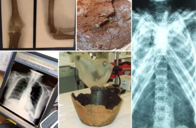 Montage photograph of x-ray images